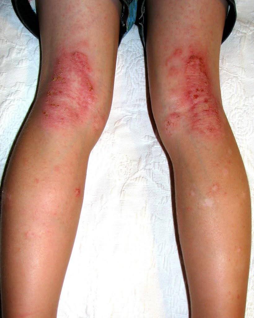 Infrared saunas offer a promising solution for managing winter eczema flare-ups