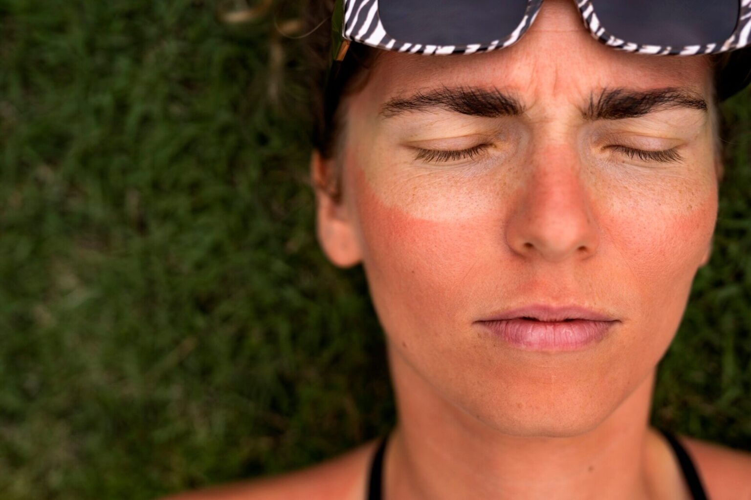 Woman with sunburn in need of relief from infrared sauna